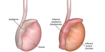 Điều trị viêm tinh hoàn bằng cách nào? Hiệu quả hay không?