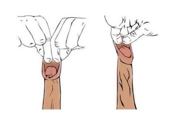 Cách điều trị hẹp bao quy đầu bằng thuốc