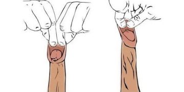 Cách điều trị hẹp bao quy đầu bằng thuốc