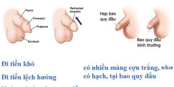 Những Triệu Chứng Của Hẹp Bao Quy Đầu