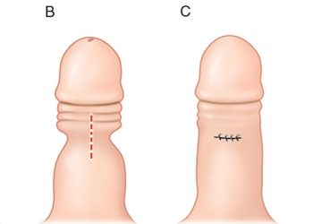 bao quy đầu bị hẹp cũng có thể dẫn đến đau đớn khi cương cứng