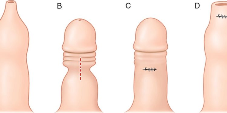 bao quy đầu bị hẹp cũng có thể dẫn đến đau đớn khi cương cứng