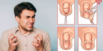 Tại sao bao quy đầu của bạn bị hẹp