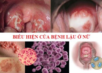 Ra khí hư màu vàng hoặc xanh lá cây