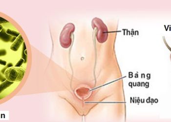 Viêm bàng quang có thể gây ra đau bụng hoặc đau lưng