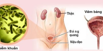 Viêm bàng quang có thể gây ra đau bụng hoặc đau lưng