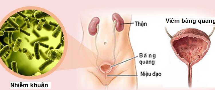 Viêm bàng quang có thể gây ra đau bụng hoặc đau lưng