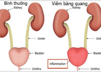 Người cao tuổi có nguy cơ cao hơn bị mắc bệnh viêm bàng quang