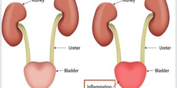 Người cao tuổi có nguy cơ cao hơn bị mắc bệnh viêm bàng quang