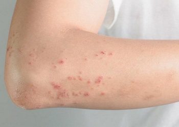 Người bệnh có thể cảm thấy cảm lạnh, đau đầu