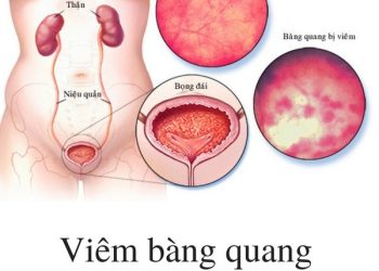 Triệu Chứng Của Viêm Bàng Quang