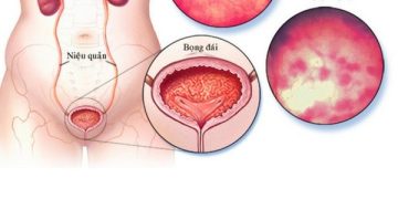 Triệu Chứng Của Viêm Bàng Quang