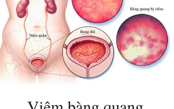 Triệu Chứng Của Viêm Bàng Quang