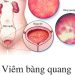 Triệu Chứng Của Viêm Bàng Quang