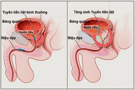 Uống đủ nước sẽ giúp đẩy các vi khuẩn ra khỏi bàng quang