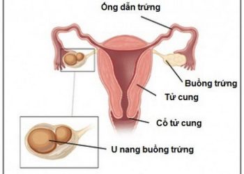 Bệnh u nang buồng trứng là do vi khuẩn Salmonella enteritidis
