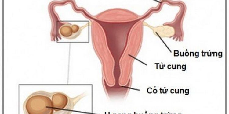 Bệnh u nang buồng trứng là do vi khuẩn Salmonella enteritidis