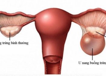 Bệnh u nang buồng trứng