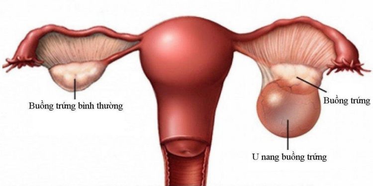 Bệnh u nang buồng trứng
