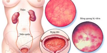 Viêm bàng quang là một tình trạng viêm nhiễm của niệu đạo