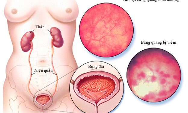 Viêm bàng quang là một tình trạng viêm nhiễm của niệu đạo