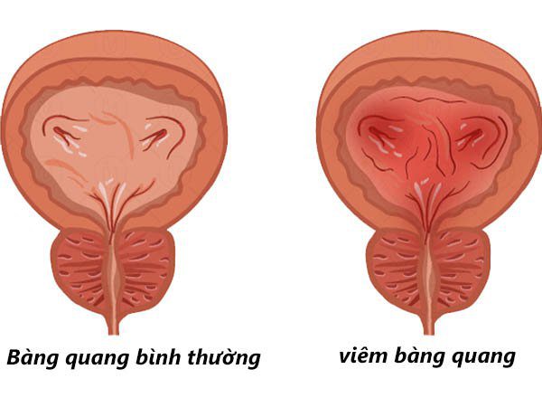 Viêm bàng quang là một trong những bệnh thường gặp ở người lớn